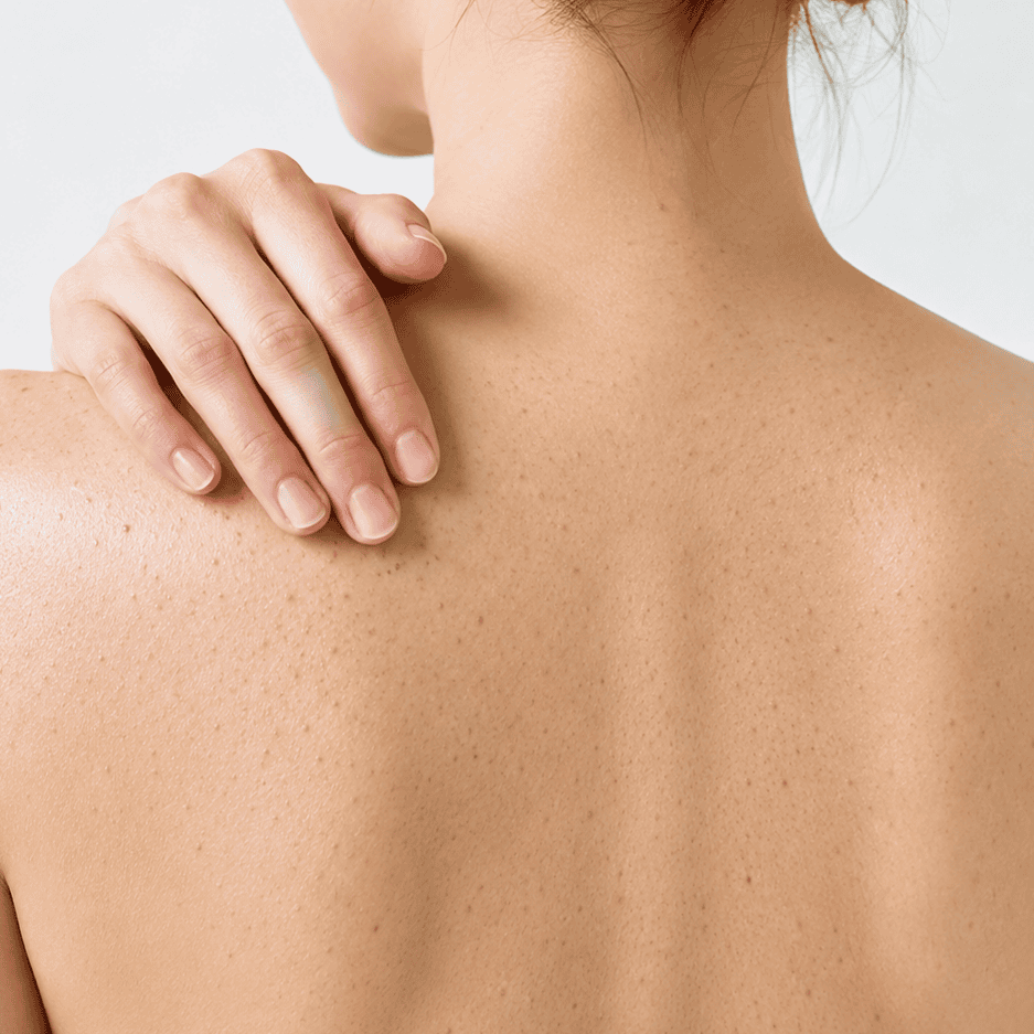 Keratosis Pilaris