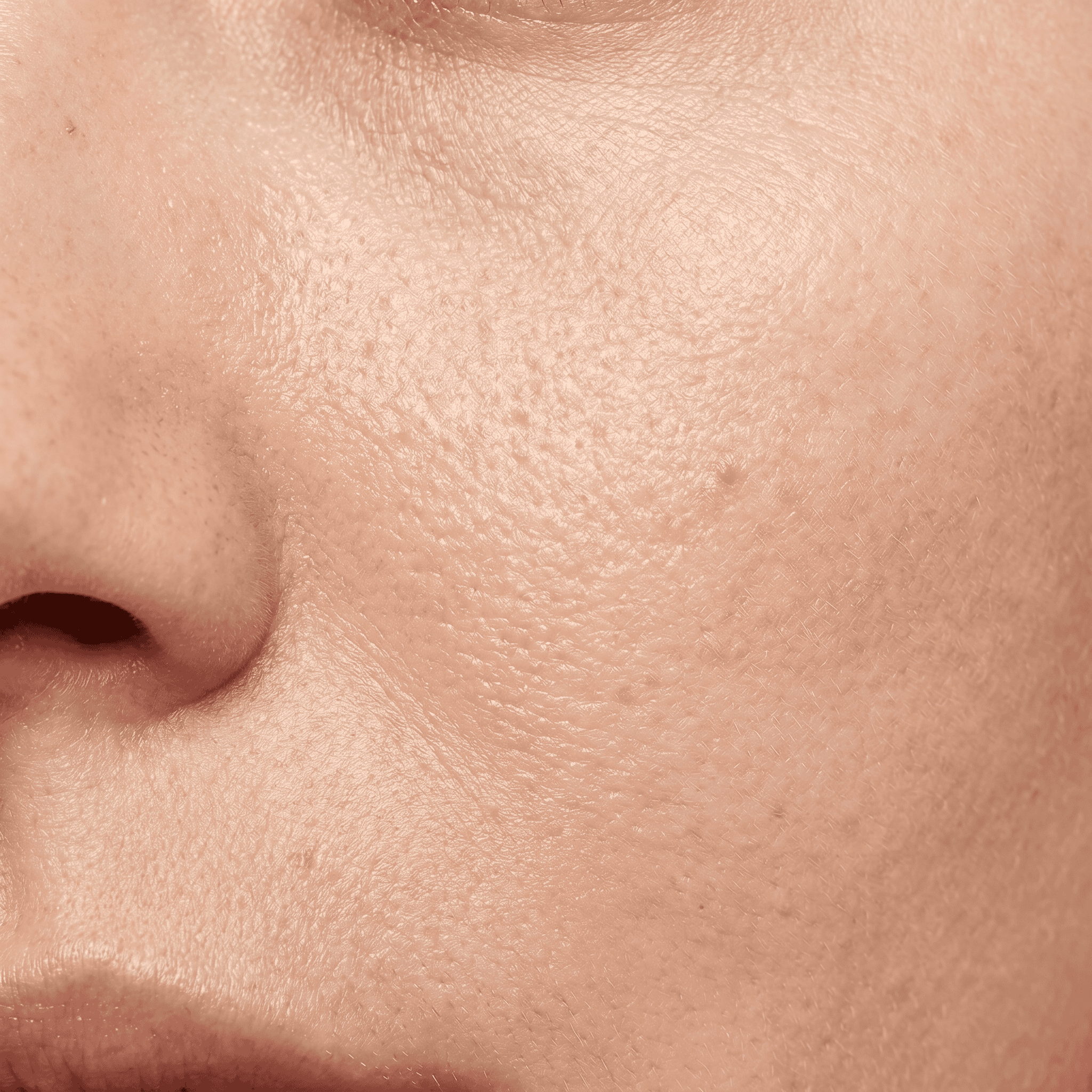 Oily shine and acne